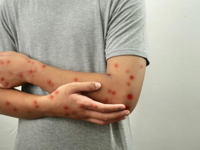 Vaiolo delle Scimmie, ecco la lista dei Paesi a rischio dove non andare